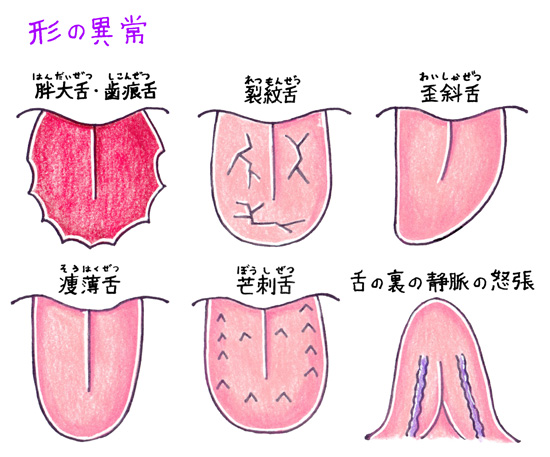 舌診イラスト: 舌診の基礎 | 舌診～舌体 – PFRKR