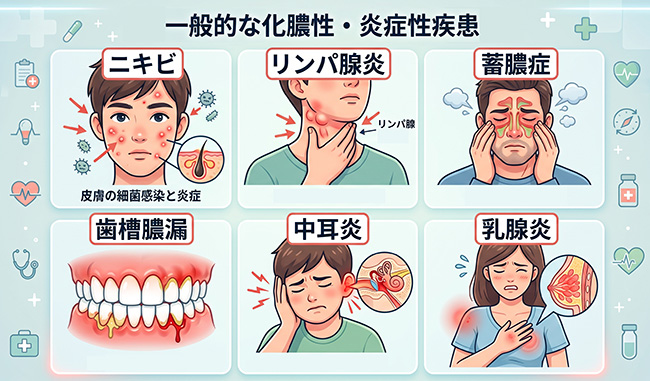 化膿性炎症疾患